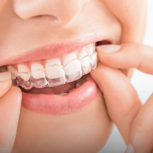 Invisalign