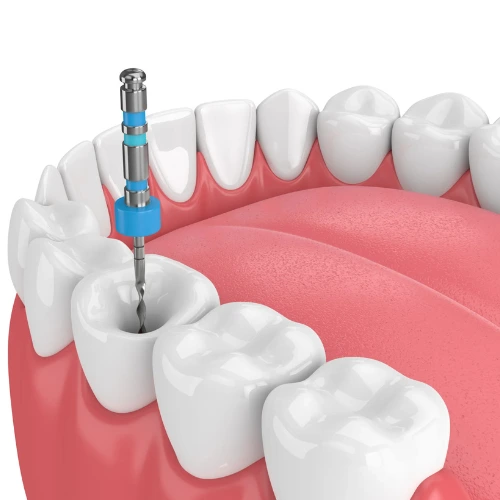 Root Canal Treatment