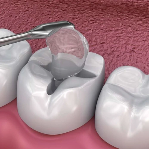 Tooth Filling