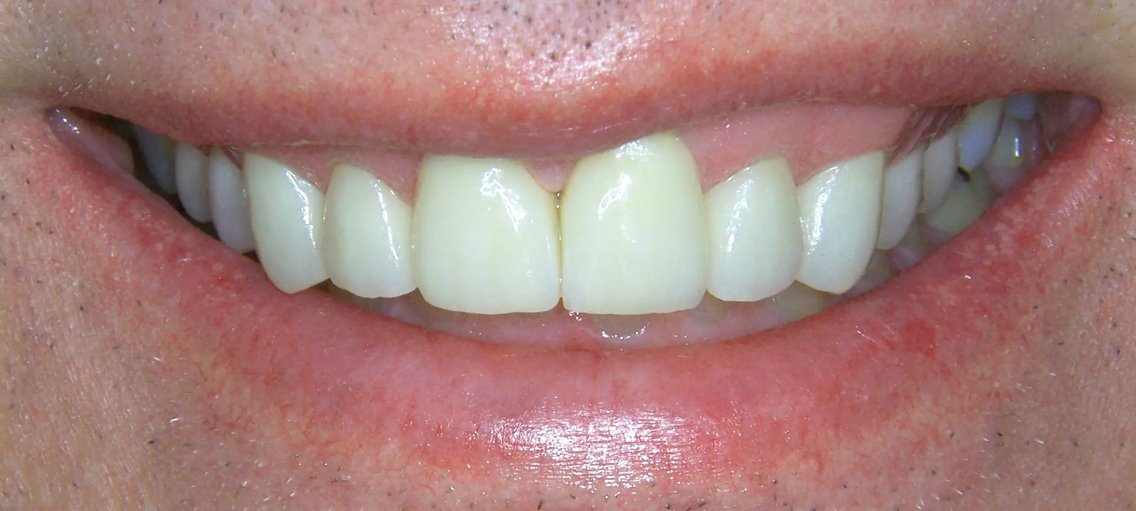 Close-up of patient’s smile after dental treatment, showing whiter teeth and improved alignment.