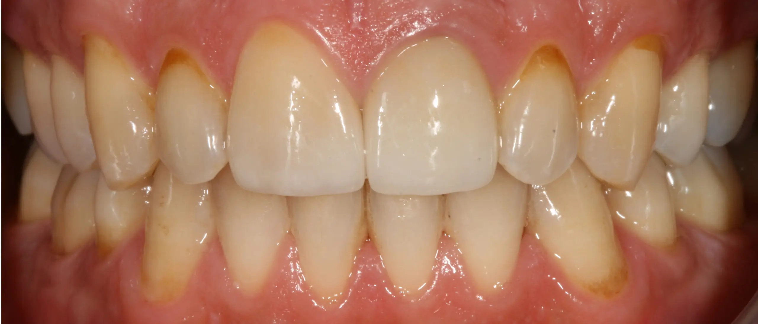 Patient Smile After Transformation (3)