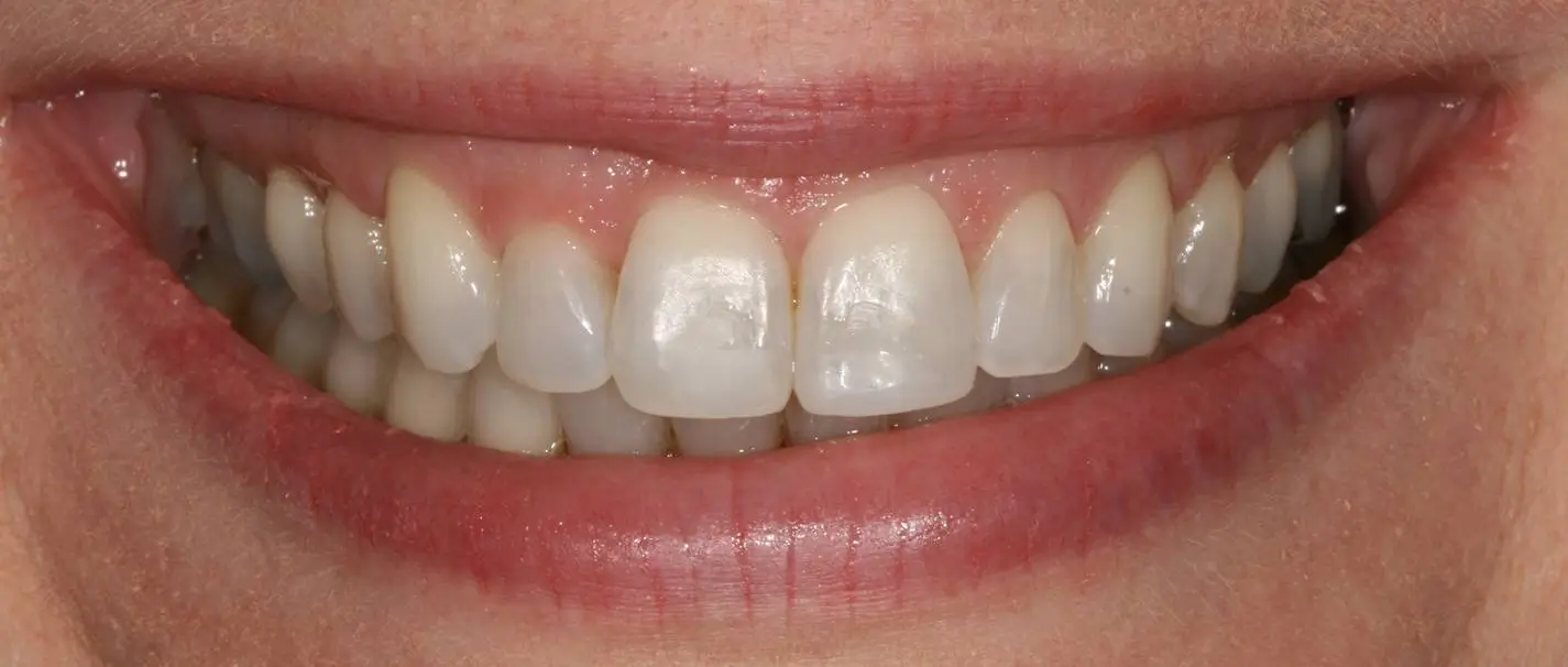 Close-up of patient’s smile after dental treatment, showing whiter teeth and improved alignment.