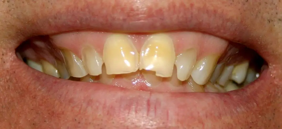 Close-up of patient’s smile before dental treatment, showing mild discoloration and uneven surfaces.