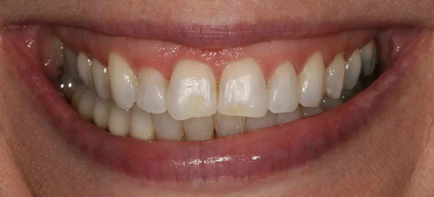 Close-up of patient’s smile before dental treatment, showing mild discoloration and uneven surfaces.