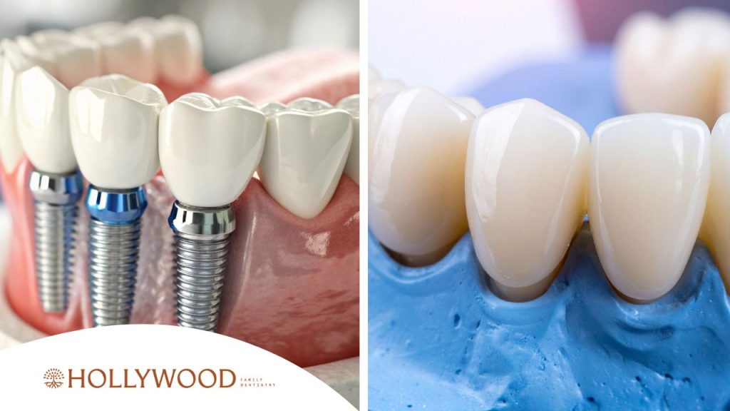 Dental Implants vs. Bridges — Which Is Right for You