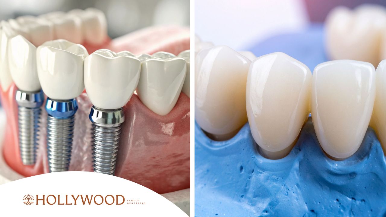 Dental Implants vs. Bridges — Which Is Right for You