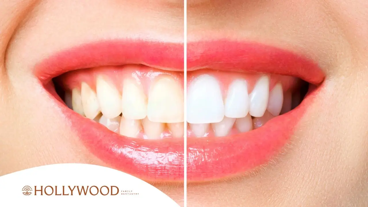 Teeth Whitening Options in Portland