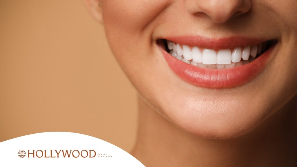 Veneers vs. Teeth Whitening