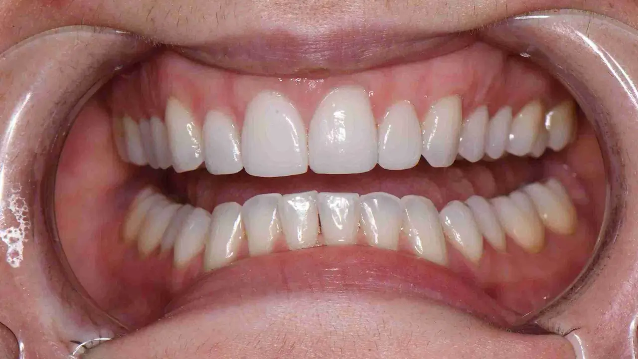 Case 1 After Retracted