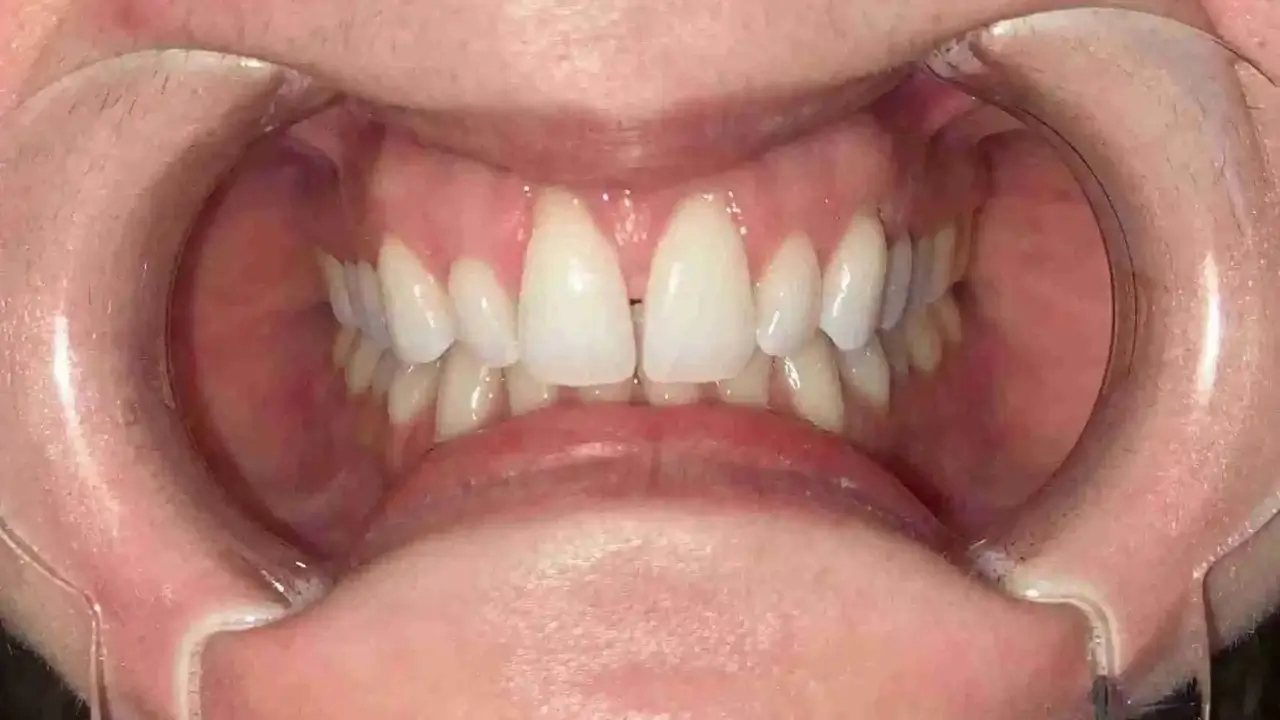 Case 1 Before Retracted