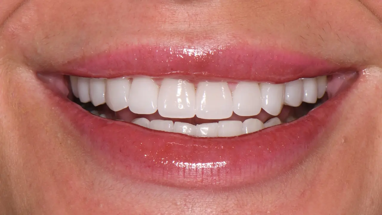 Case 2 After Smile