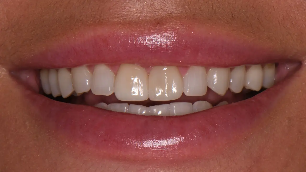Case 2 Before Smile